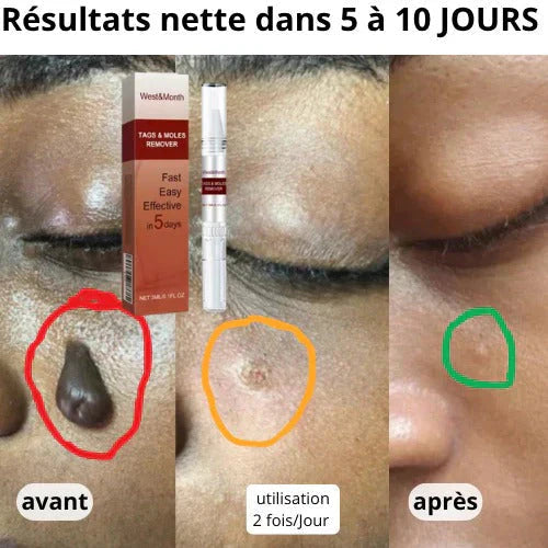 Essence(stylo) pour enlever des acrochordons, taches et grains de beauté.
